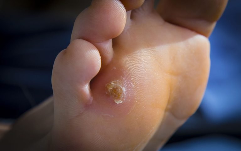 58286007 - painful corn on foot. close up
